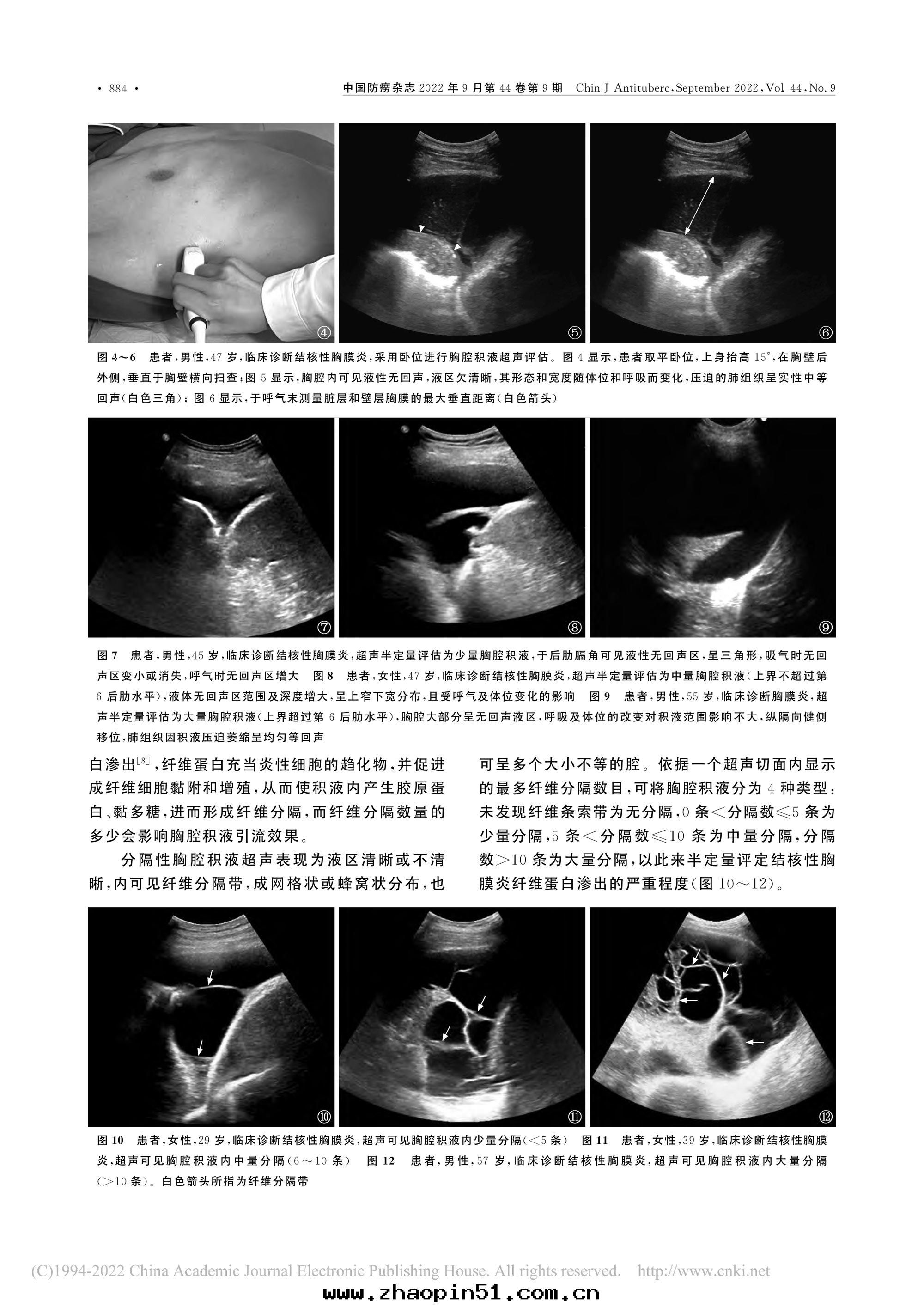2022結核性(xìng)胸膜炎超聲診斷、分(fēn)型及介入(rù)治療專家共(gòng)識(2022年(nián)版)-5.jpg